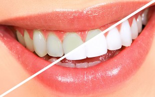 جرم گیری با بروساژ دندانپزشکی دکتر رهبر