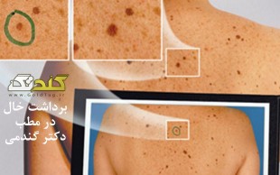 خال برداری با دستگاه RF