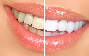 خدمات زیبایی دندان در مطب دکتر هانیه پژمان