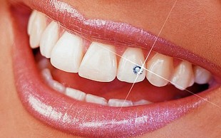 کاشت نگین دندان در دندانپزشکی رهبر