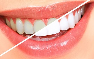 بلیچینگ دو فک در مطب دکتر هانیه پژمان