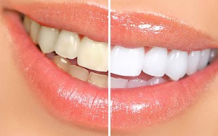 جرم گیری دو فک با بروساژ در لبخند سفید