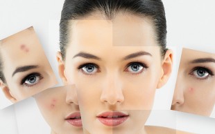 پیگمانته تراپی و درمان  جای جوش در مطب صبا