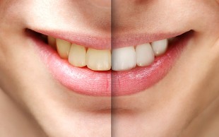 جرم گیری و بروساژ دو فک دکتر سولماز امانی