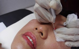 آکنه تراپی و درمان کامل جوش در مطب صبا