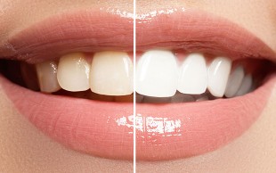 جرم گیری در دندانپزشکی رها