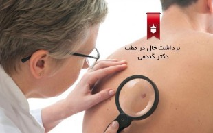 خال برداری با دستگاه RF