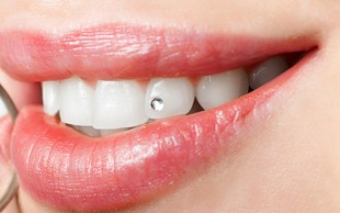 کاشت نگین دندان دکتر حورا ندیمی