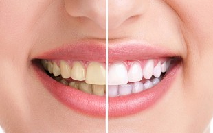 جرم گیری و بروساژ کلینیک دولت