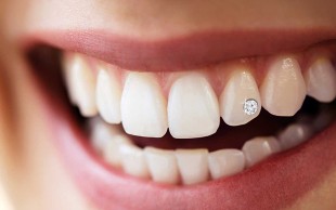 کاشت نگین دندان دکتر ملک زاده