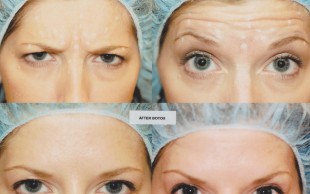 بوتاکس در ساختمان پزشکان بهنوش