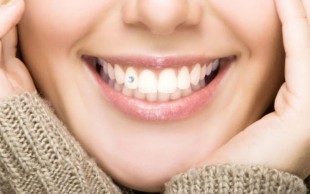 کاشت نگین دندان - دکتر علیجانی