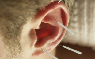 طب سوزنی در موسسه ی 5 عنصر