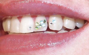 کاشت نگین دندان کلینیک لبخند سفید