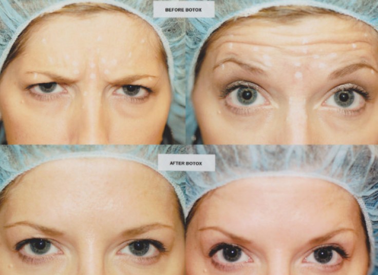 بوتاکس در ساختمان پزشکان بهنوش