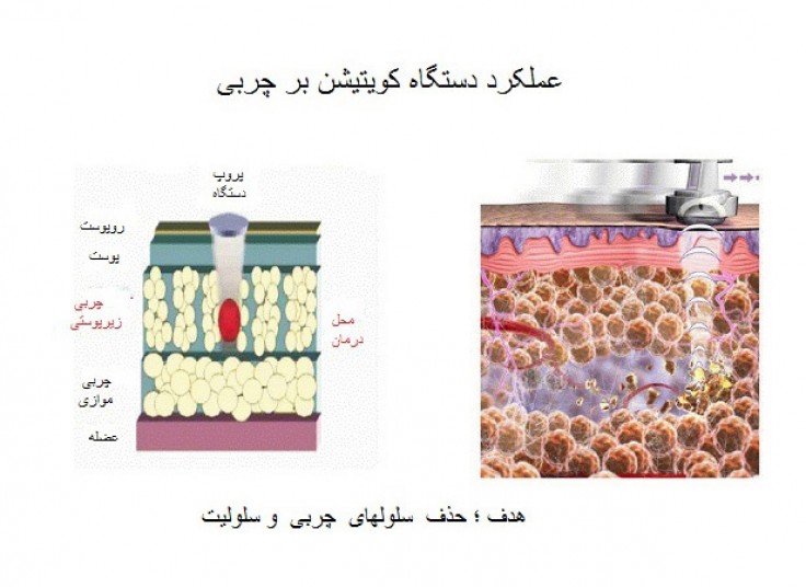 RF و کویتیشن در کلینیک سینامید