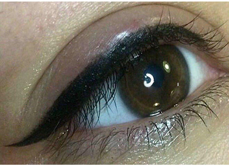 میکروپیگمنتیشن سالن نیلای