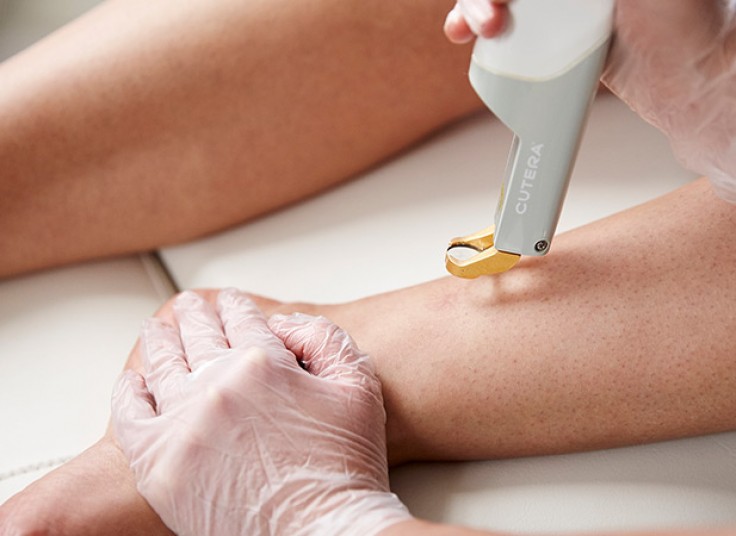 لیزر الکس سایناشور در کلینیک تندیس