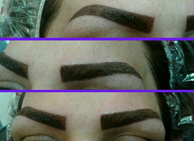 میکروپیگمنتیشن سالن الیا