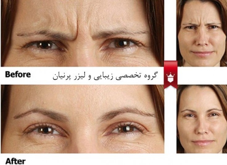 تزریق بوتاکس کلینیک پرنیان