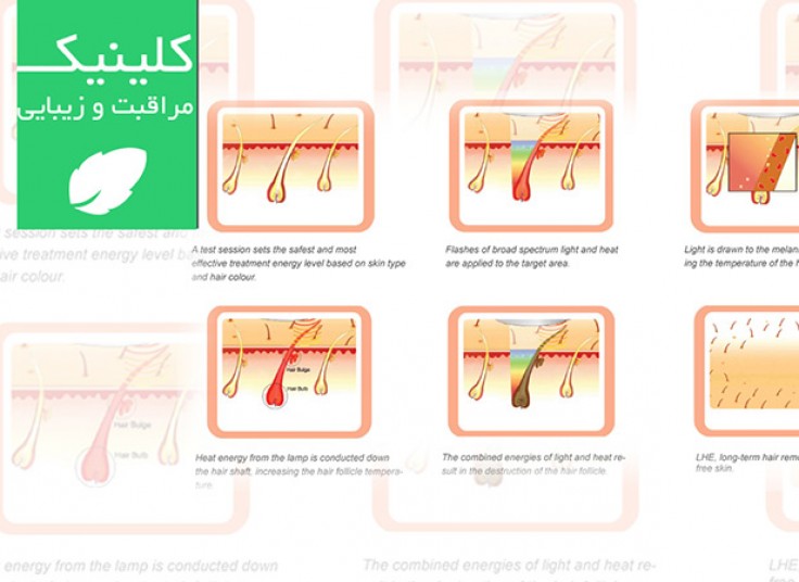 لیزر الکساندرایت سوپرینو  دکتر مهوروش