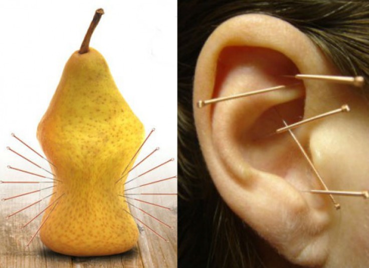 طب سوزنی در موسسه ی 5 عنصر