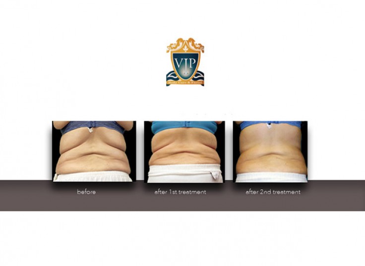 ونکوییش در کلینیک VIP فرشته