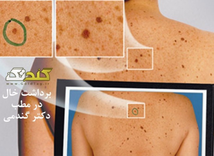 خال برداری با دستگاه RF