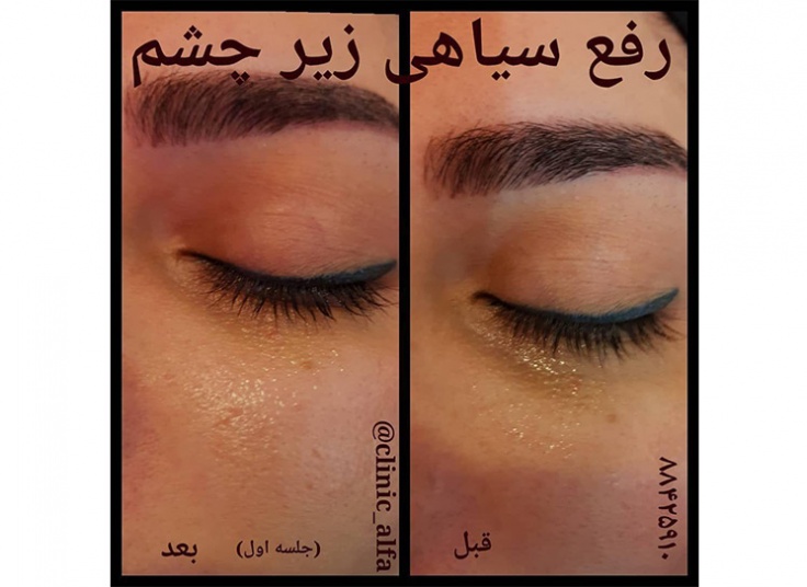رفع سیاهی دور چشم در کلینیک آلفا