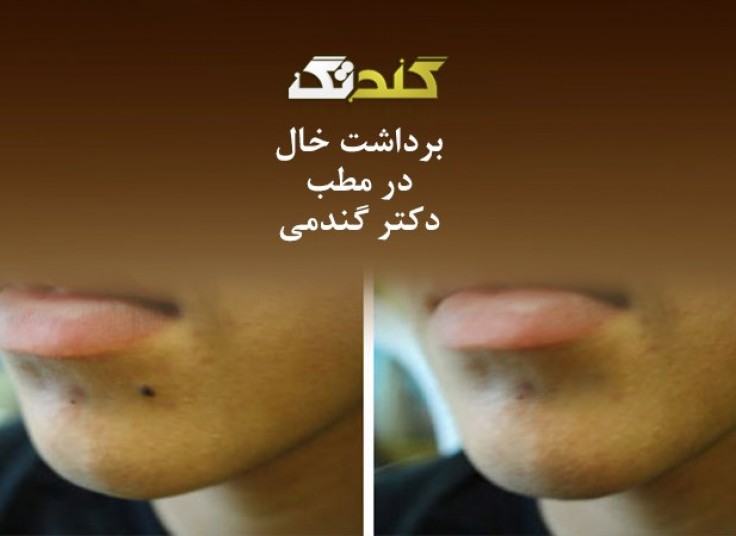 خال برداری با دستگاه RF