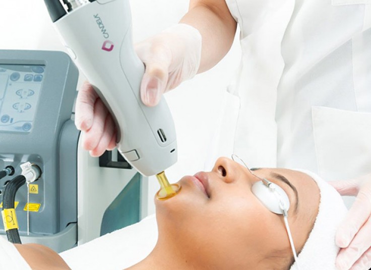 لیزر الکس کندلا در کلینیک ماهان