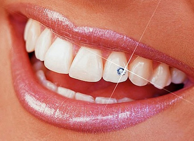 کاشت نگین دندان در دندانپزشکی رهبر