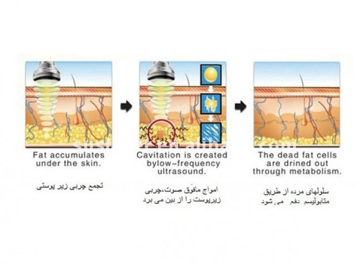 RF و کویتیشن در کلینیک سینامید