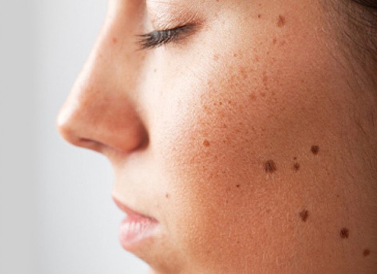 رفع لک و آکنه تراپی در کلینیک آفتاب تابان