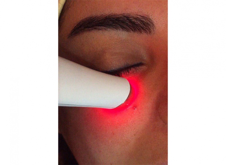 رفع سیاهی دور چشم در کلینیک آلفا