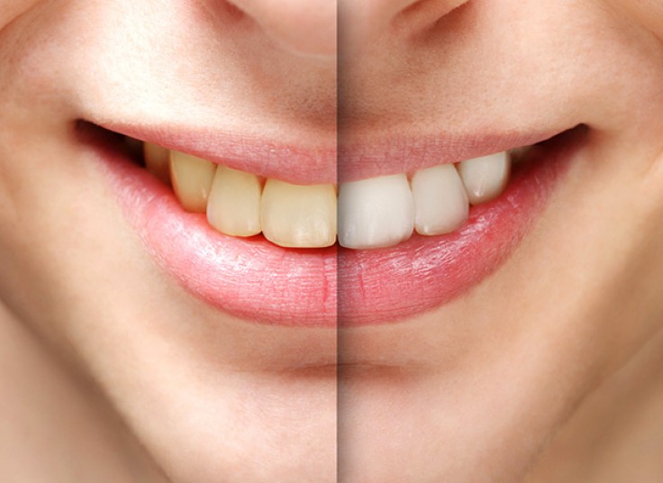 جرم گیری و بروساژ دو فک دکتر سولماز امانی