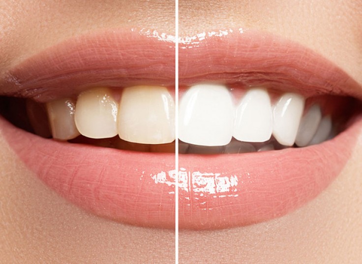 جرم گیری در دندانپزشکی رها