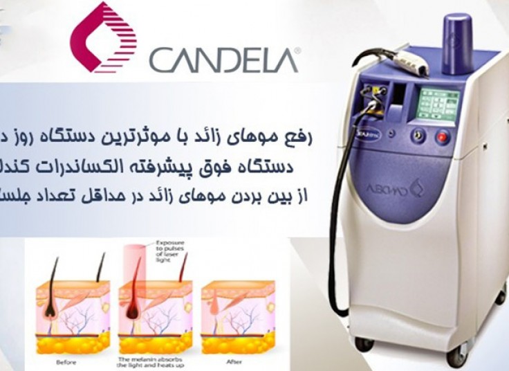 لیزر الکس کندلا 2017 در کلینیک دکتر کیانی