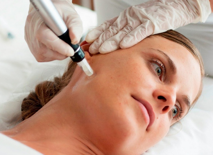 میکرونیدلینگ کلینیک تندیس