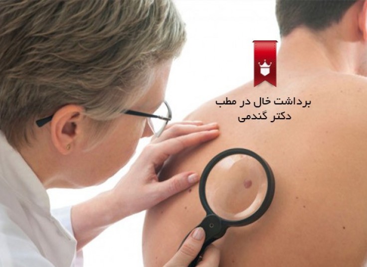 خال برداری با دستگاه RF