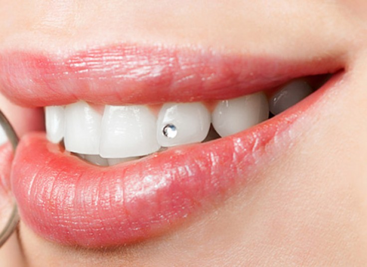 کاشت نگین دندان دکتر حورا ندیمی