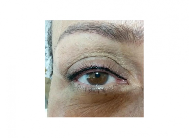 میکروپیگمنتیشن مجموعه افسانه