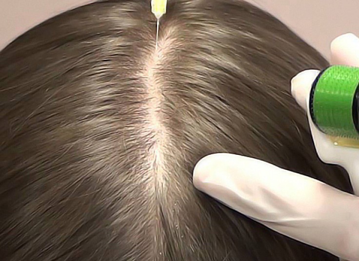 مزوتراپی سر کلینیک مهراد