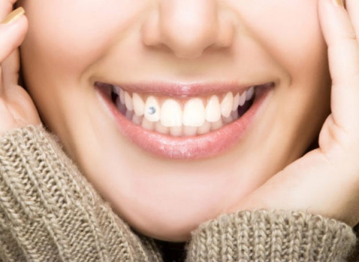 کاشت نگین دندان - دکتر علیجانی