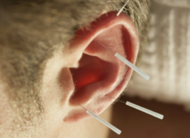 طب سوزنی در موسسه ی 5 عنصر