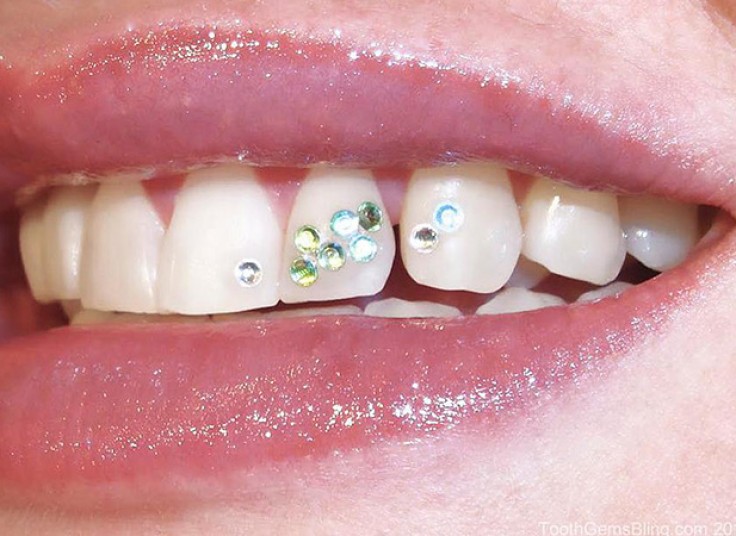 کاشت نگین دندان کلینیک لبخند سفید