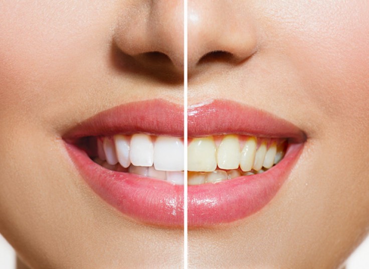 جرم گیری و بروساژ دو فک در دندانپزشکی رهبر