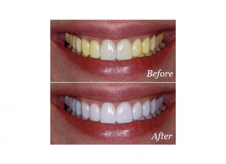 جرم گیری با بروساژ دکتر شهاب قناییان